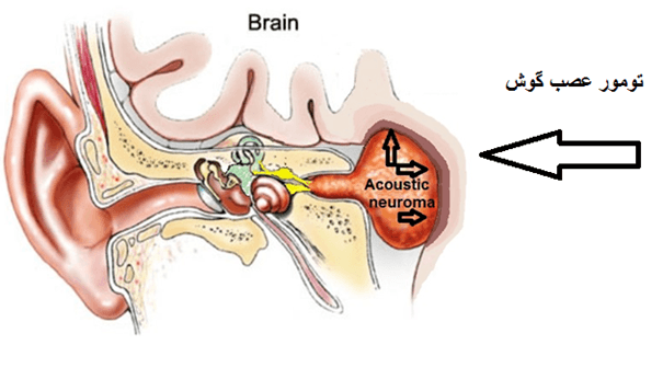 تومور عصب شنوایی