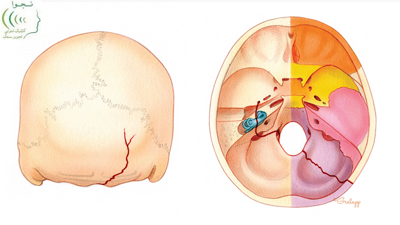 شکستگی استخوان تمپورال