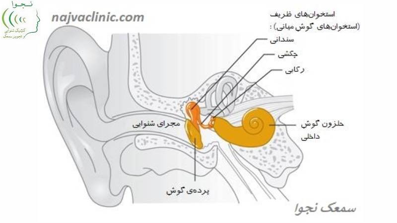 سکته گوش یا کم شنوایی ناگهانی چیست؟