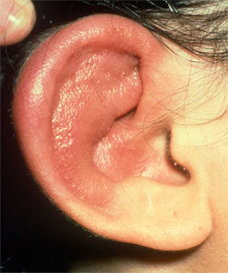 انواع بیماریهای گوش خارجی
