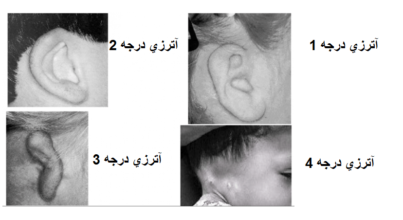 هرآنچه كه در باره آترزي گوش بايد بدانيم